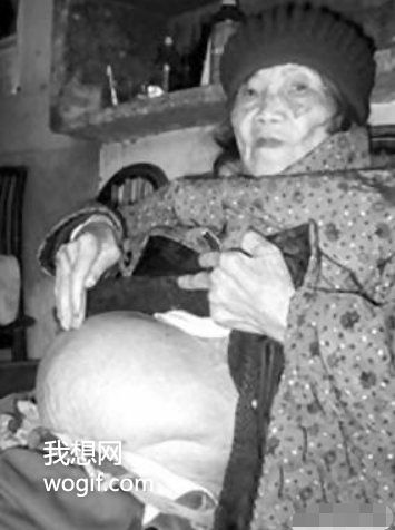 四川一91歲老奶奶不慎摔倒，到醫院后發現懷孕了（60年前懷上的）